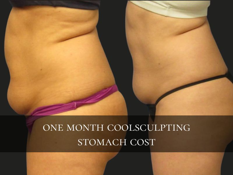 1 month coolsculpting stomach cost