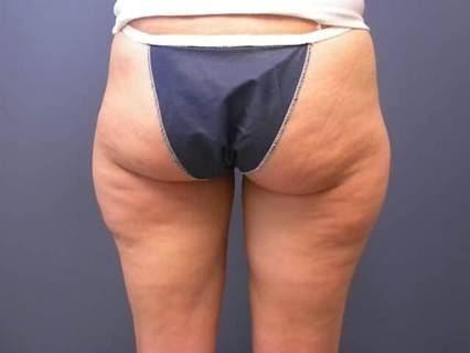 Thigh Liposuction Case 2