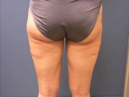 Thigh Liposuction Case 2
