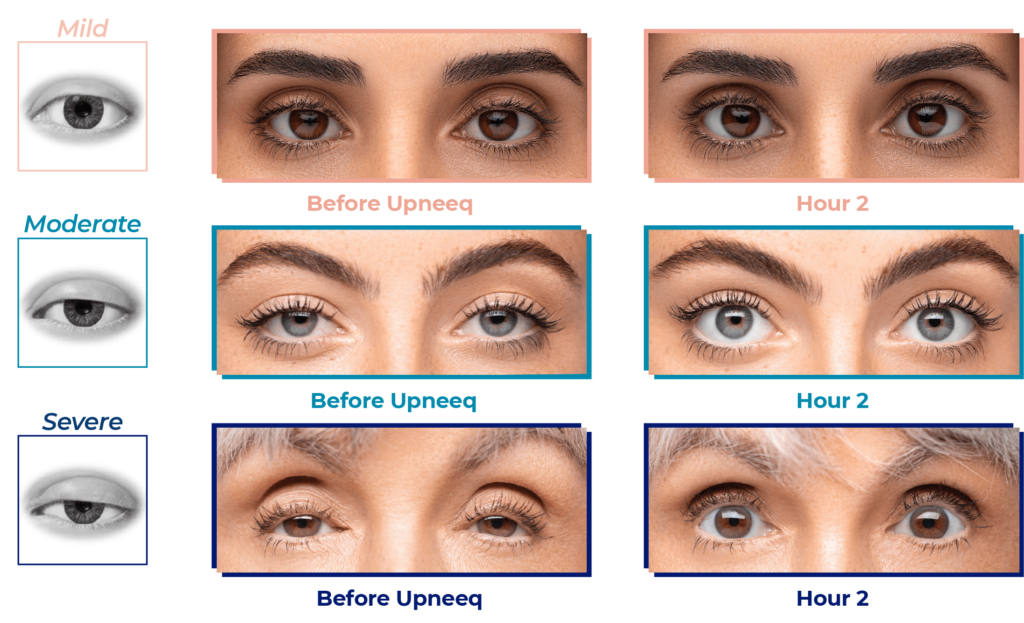 UpNeeq drops for droopy eyelids before and after pictures
