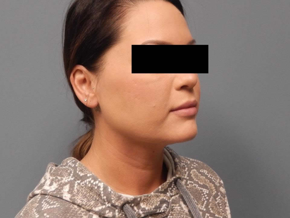 After Submental Liposuction