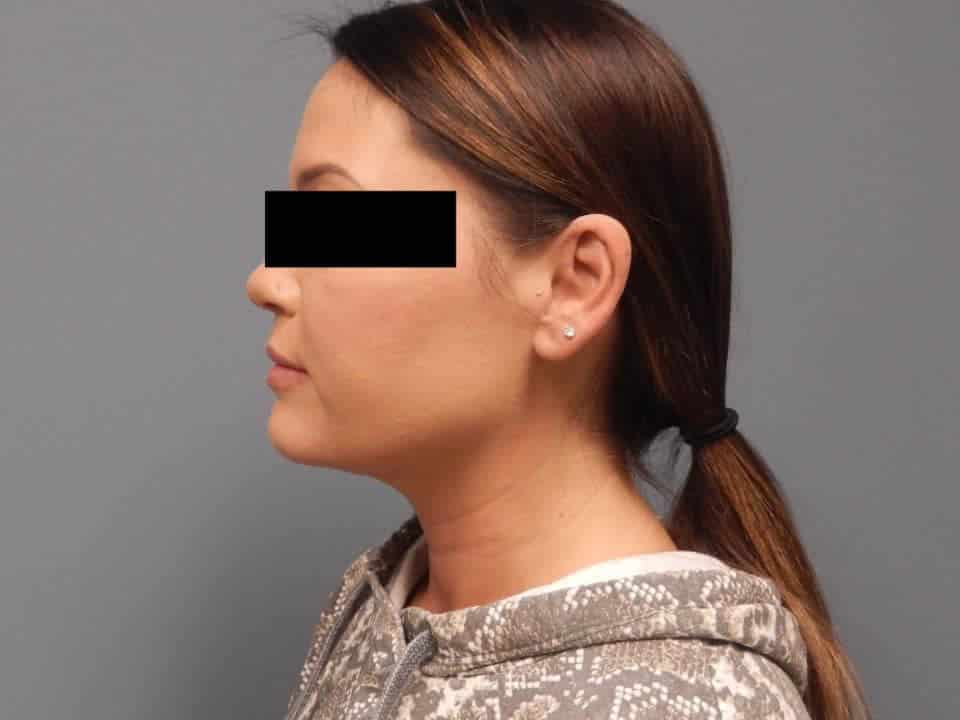 After Submental Chin Liposuction
