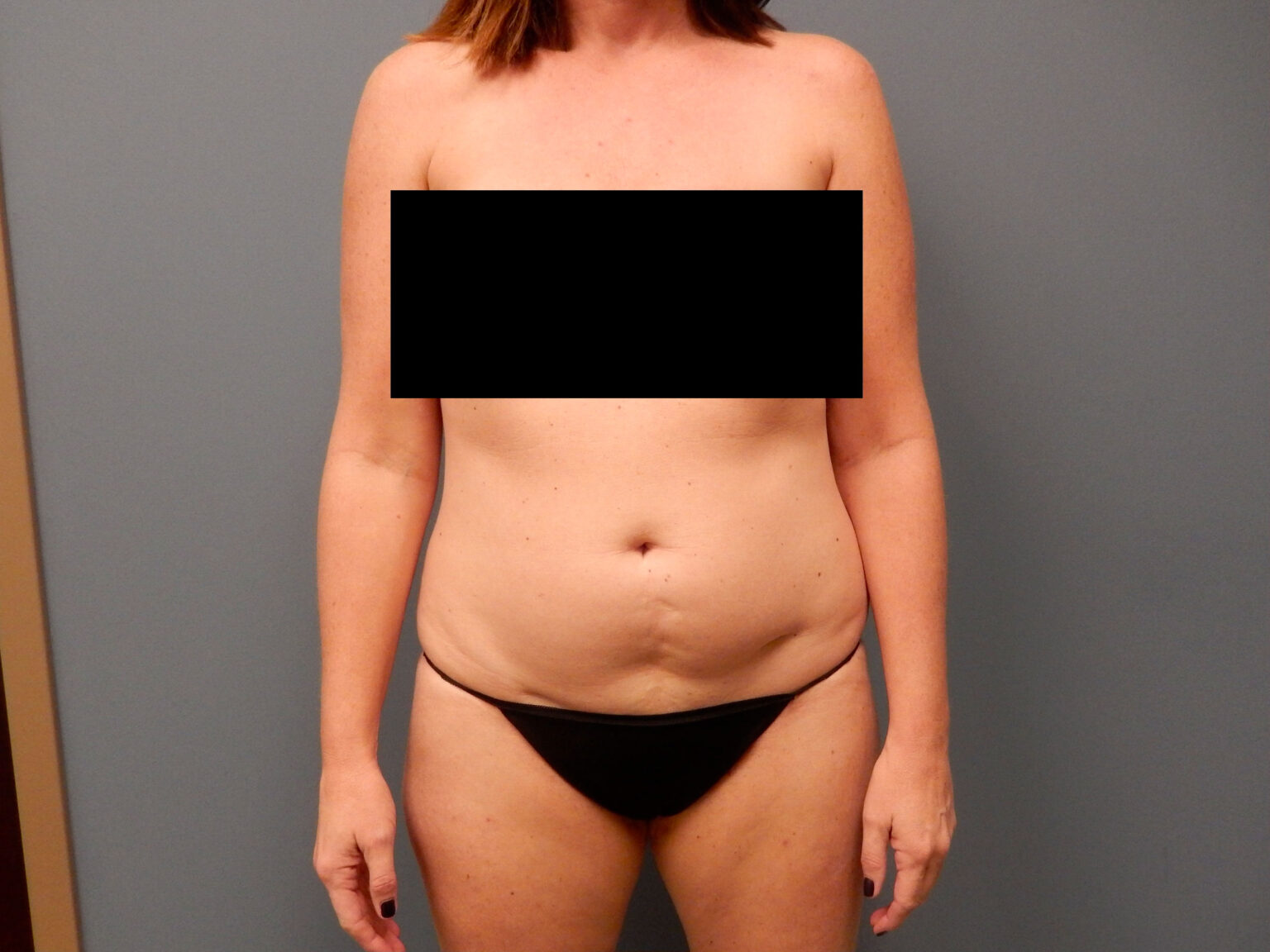 Patient 7 lipo 01