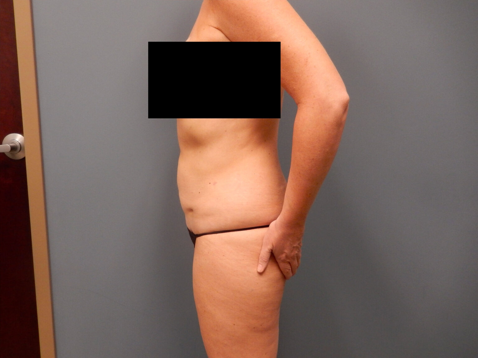 Patient 7 lipo 04