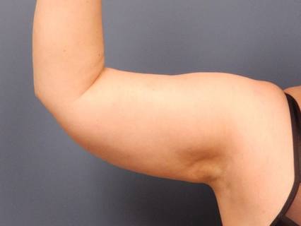 arm-liposuction--3236