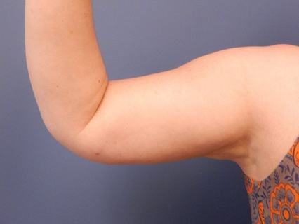 arm-liposuction--3237
