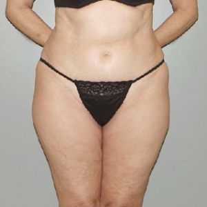 body abdominal liposuction 3060 1