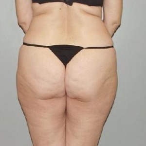 body abdominal liposuction 3062 1