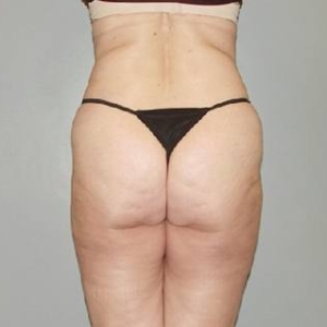 body abdominal liposuction 3063 1