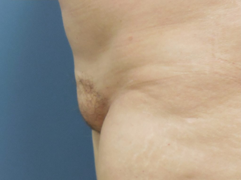 body mons liposuction 4709