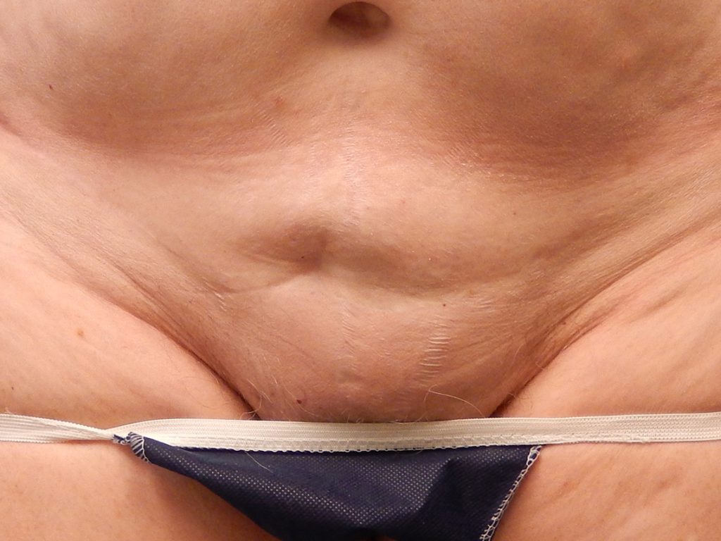 body mons liposuction 4711