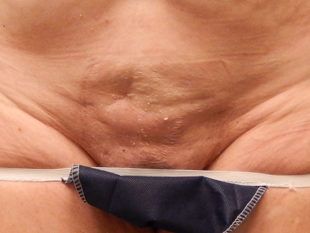 body mons liposuction 4712