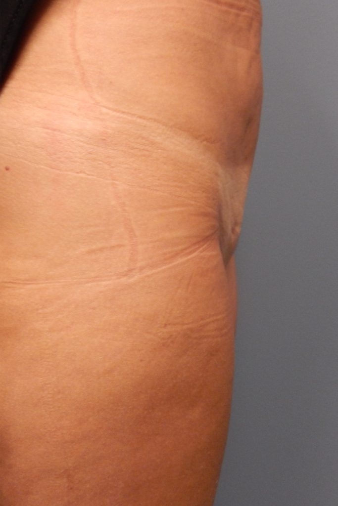 body mons liposuction 4717