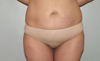 body tummy tuck abdominoplasty 2883