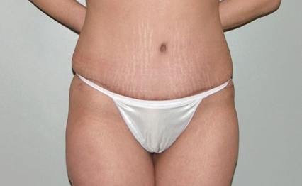body tummy tuck abdominoplasty 2884
