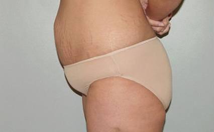 body tummy tuck abdominoplasty 2885
