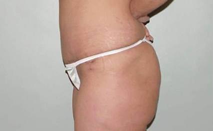 body tummy tuck abdominoplasty 2886