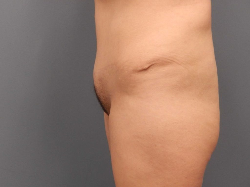 mons liposuction 4674