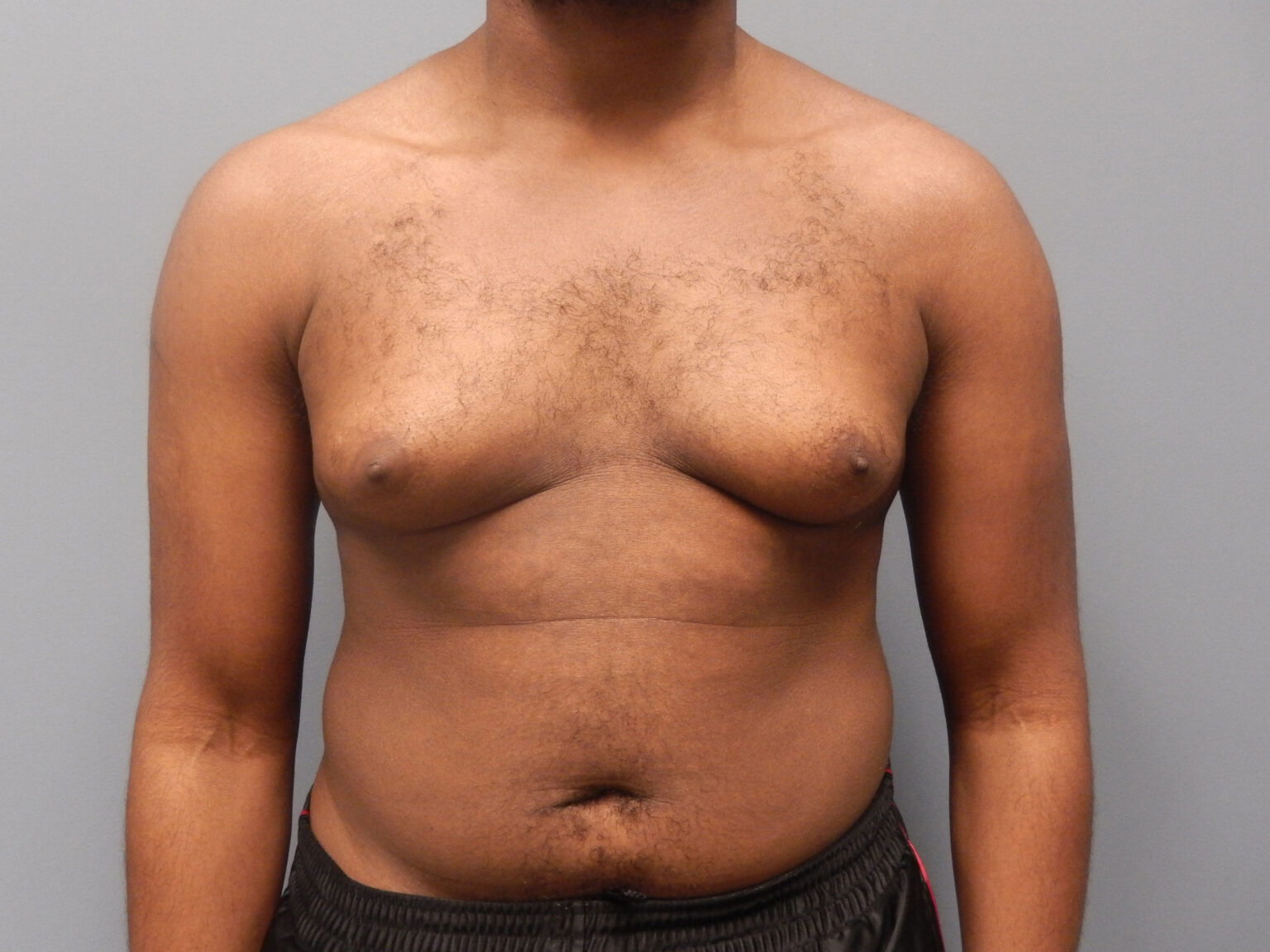 Patient 137 2mo male chest 01