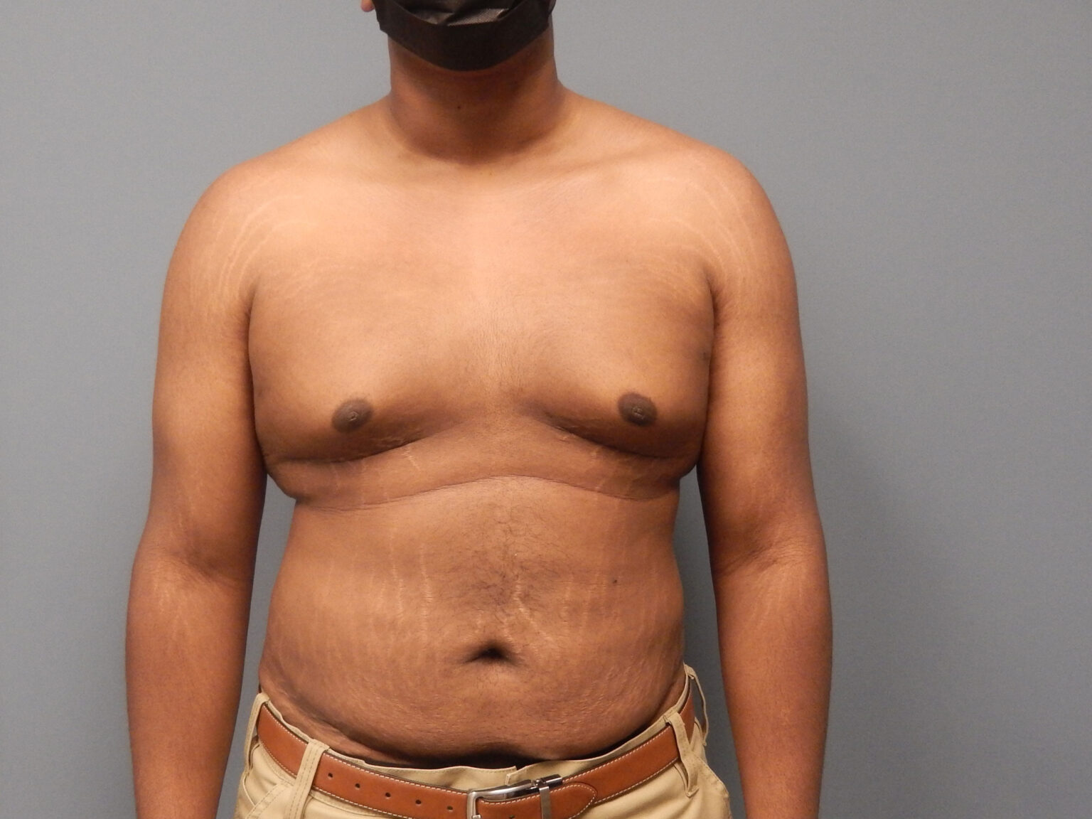 Patient 139 3mo male chest 02