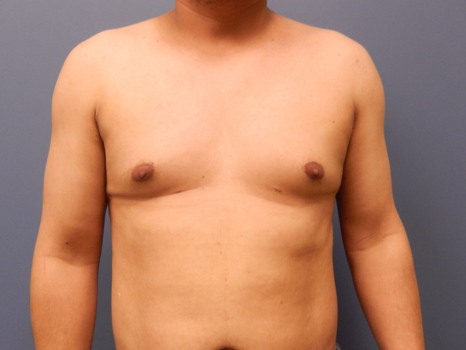 Patient 97 6 mo Male Chest 02