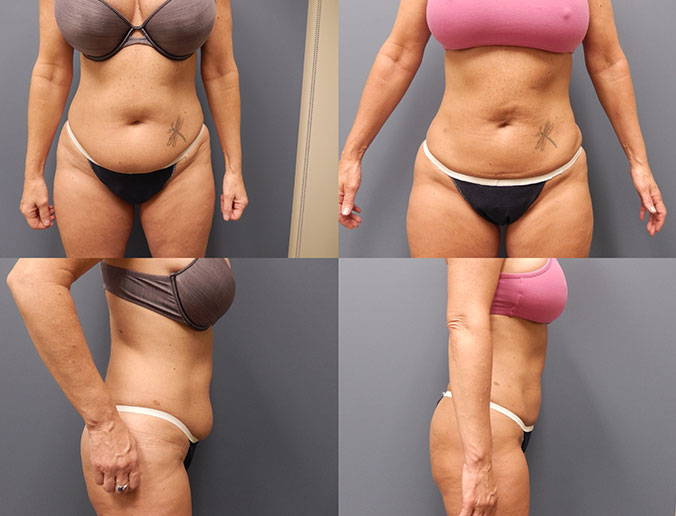 Abdominal Liposuction Raleigh Patient 113