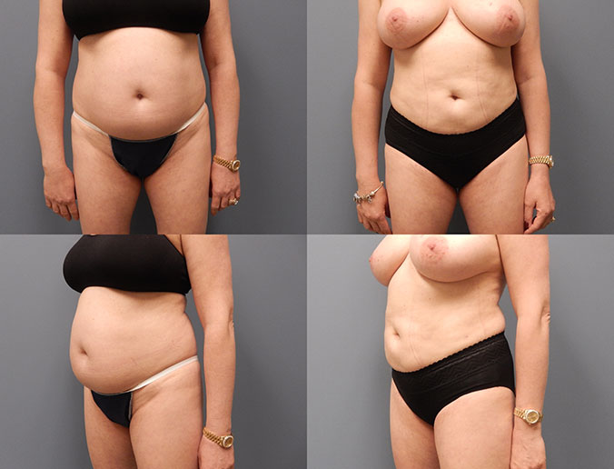 Abdominal Liposuction Raleigh Patient 118