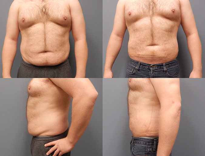 Abdominal Liposuction Raleigh Patient 120 3 weeks