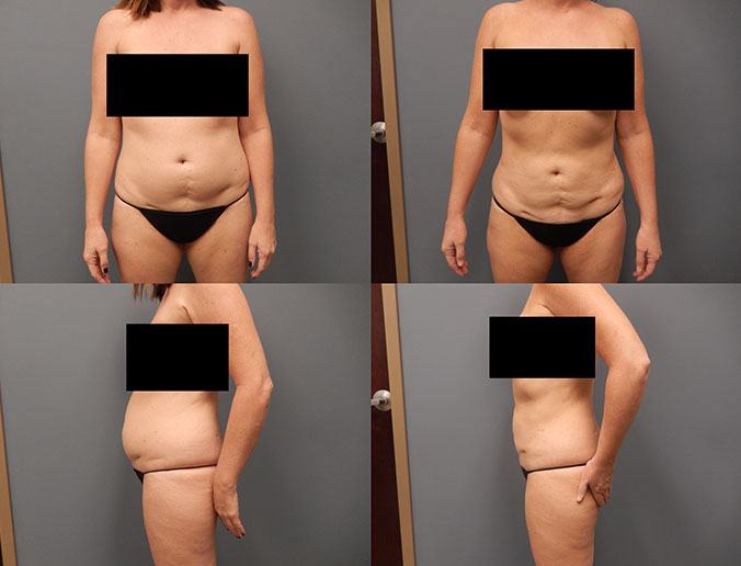 Abdominal Liposuction Raleigh Patient 175