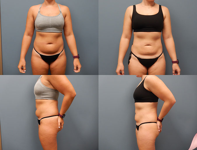 Abdominal Liposuction Raleigh Patient 186