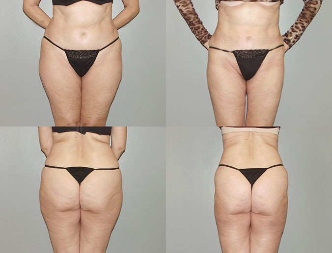 Abdominal Liposuction Raleigh patient 2