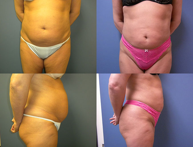 Abdominal Liposuction Raleigh patient 21 2