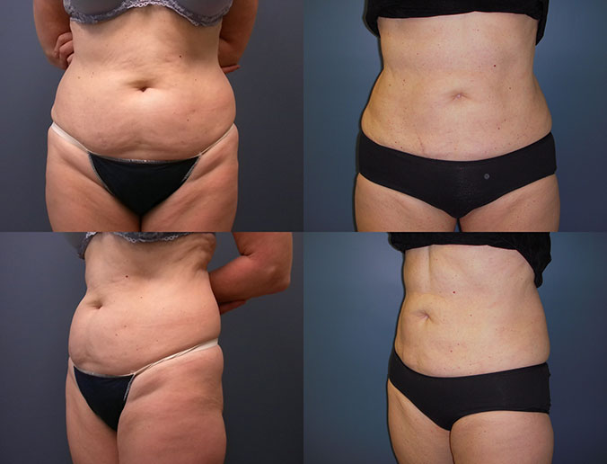 Abdominal Liposuction Raleigh patient 25