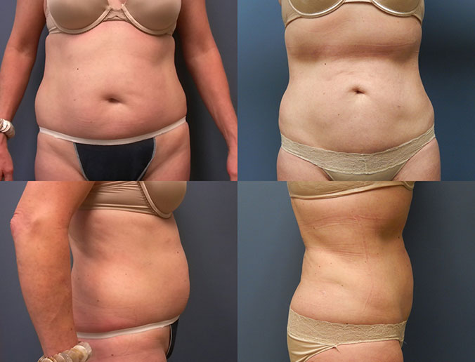 Abdominal Liposuction Raleigh patient 31 3