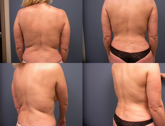 Abdominal Liposuction Raleigh patient 44