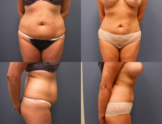 Abdominal Liposuction Raleigh patient 50