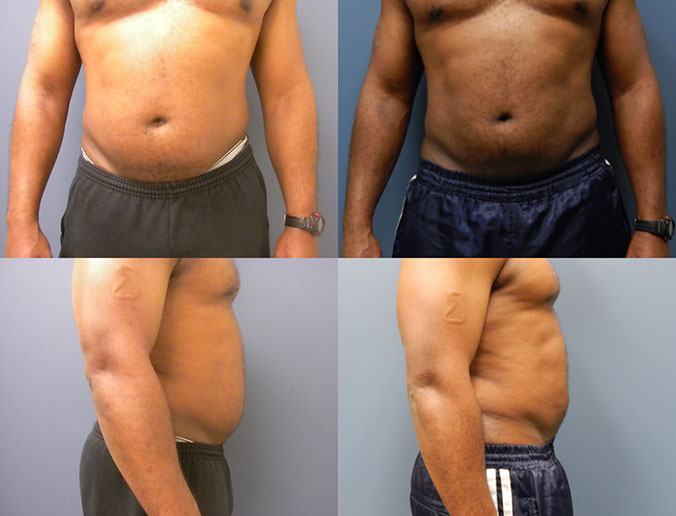 Abdominal Liposuction Raleigh patient 87