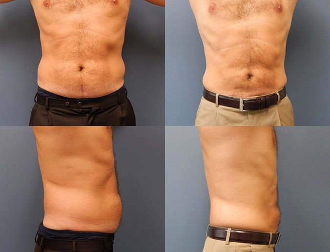 Abdominal Liposuction Raleigh patient 91