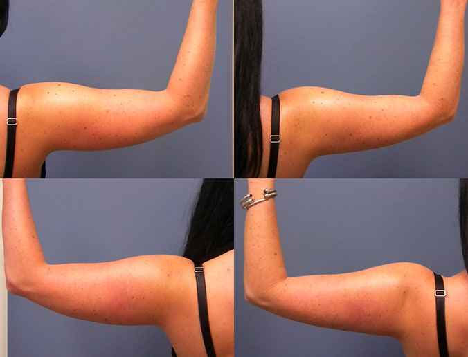 Arm Liposuction Raleigh Patient 14 1