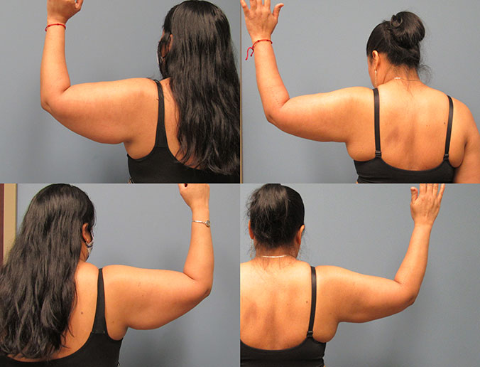 Arm Liposuction Raleigh Patient 24 1 month