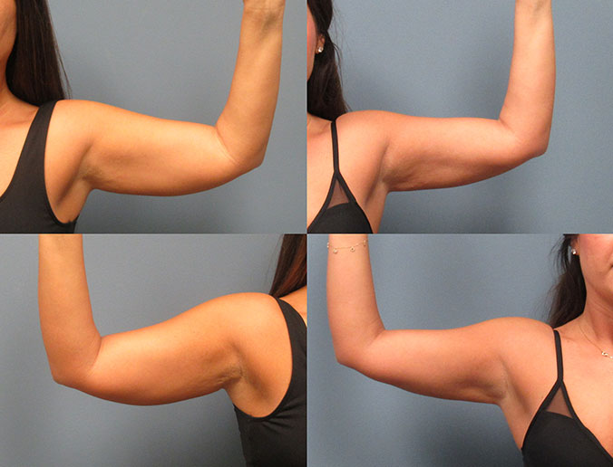 Arm Liposuction Raleigh Patient 26