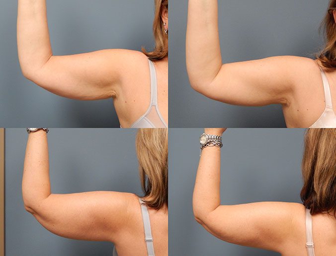 Arm Liposuction Raleigh Patient 27