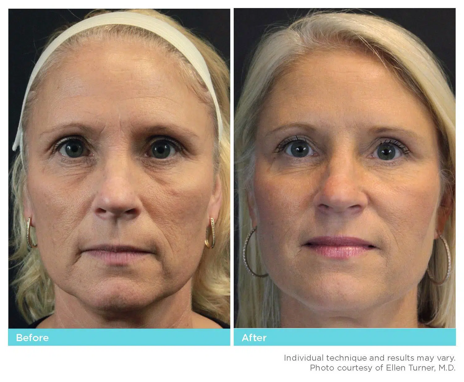 Before & After Silhouette InstaLift