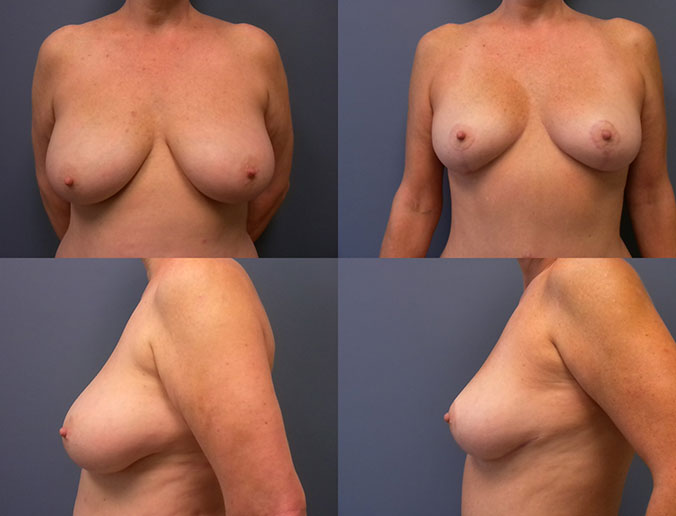 Breast Reduction Raleigh Patient 11