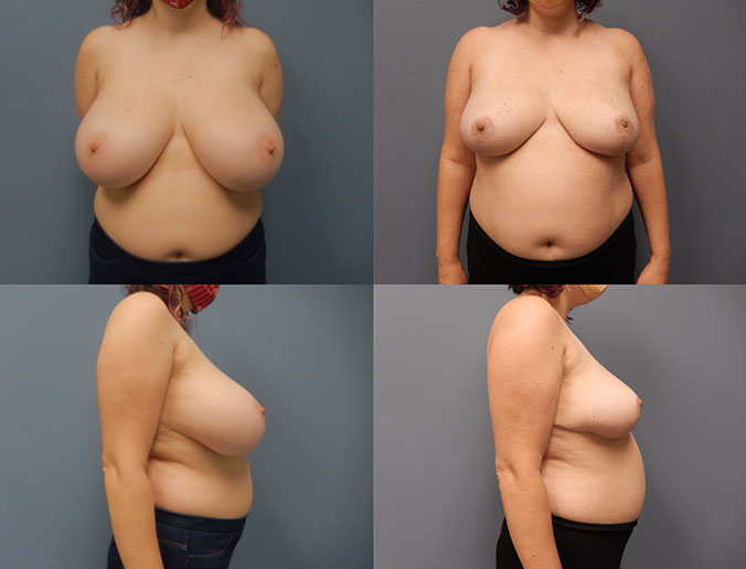 Breast Reduction Raleigh Patient 113