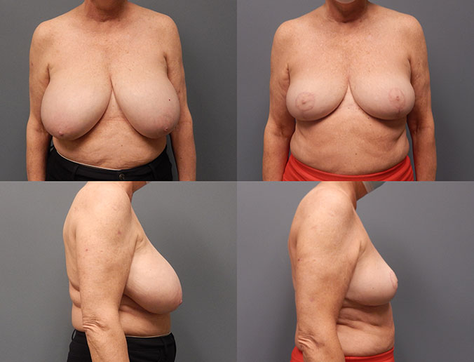 Breast Reduction Raleigh Patient 114 4 months