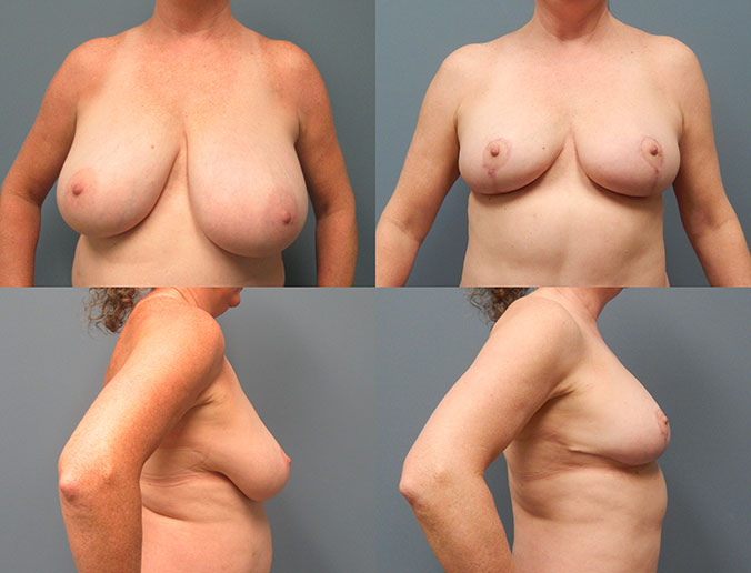 Breast Reduction Raleigh Patient 120