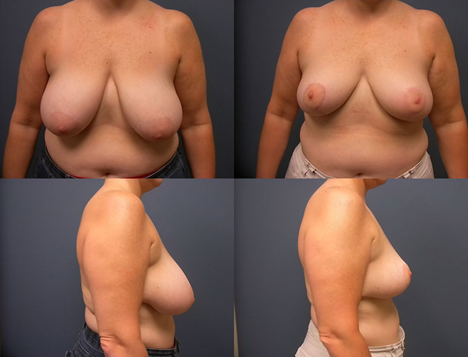 Breast Reduction Raleigh Patient 16