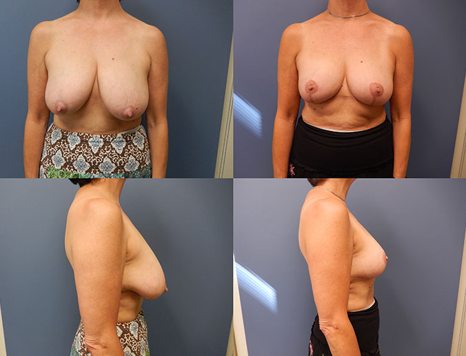 Breast Reduction Raleigh Patient 20 2