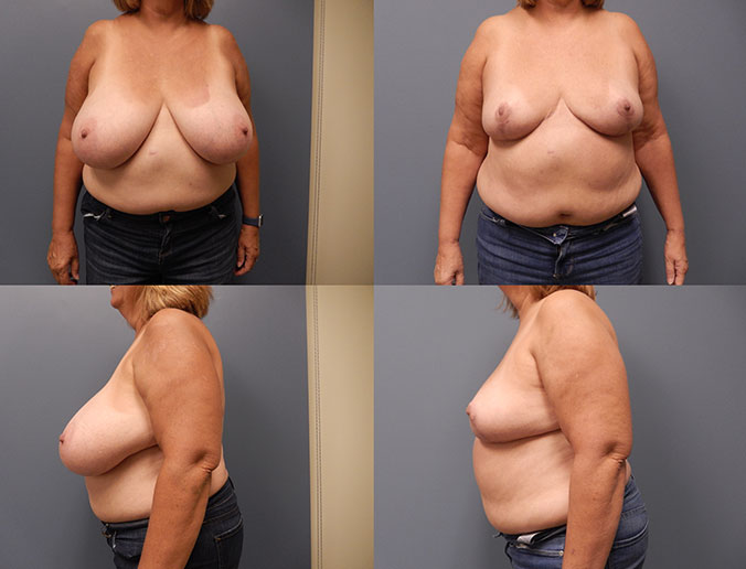 Breast Reduction Raleigh Patient 24 2